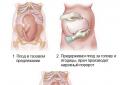 Rotasi obstetrik eksternal VS operasi caesar - apa yang dipilih dokter untuk presentasi bokong?