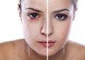 Piling kože nakon ultrazvučnog čišćenja lica Piling nakon mehaničkog čišćenja lica