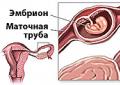 Причины, симптомы и медицинская помощь при беременность в маточной трубе